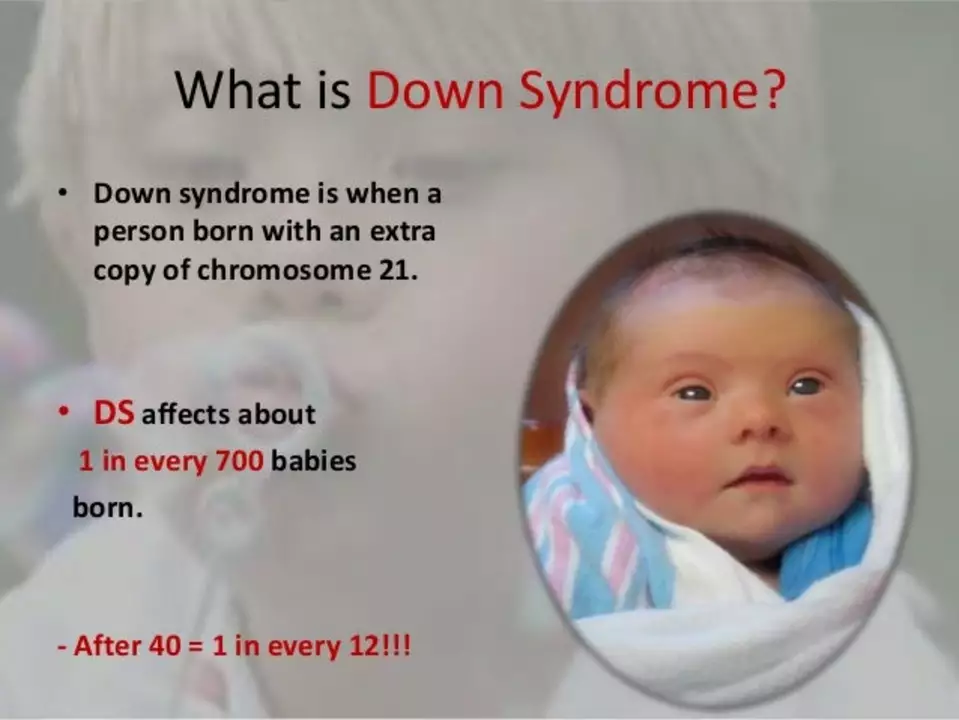 Why do I have to have Down syndrome features?